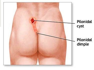 Kıl Dönmesi -Pilonidal Kist